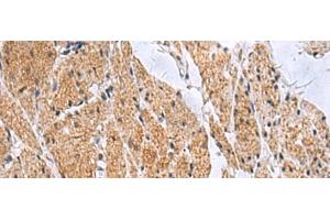 Immunohistochemistry of paraffin-embedded Human esophagus cancer tissue using SLC4A3 Polyclonal Antibody at dilution of 1:35(x200) (SLC4A3 抗体)