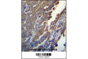 ASB4 Antibody immunohistochemistry analysis in formalin fixed and paraffin embedded human ovarian carcinoma followed by peroxidase conjugation of the secondary antibody and DAB staining.