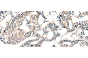 Immunohistochemistry of paraffin-embedded Human liver cancer tissue using CORO2A Polyclonal Antibody at dilution of 1:45(x200) (CORO2A 抗体)