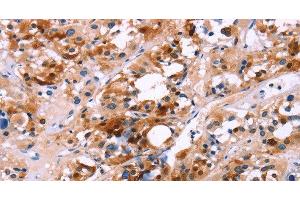 Immunohistochemistry of paraffin-embedded Human thyroid cancer using CALB1 Polyclonal Antibody at dilution of 1:60 (CALB1 抗体)