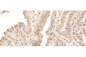 Immunohistochemistry of paraffin-embedded Human thyroid cancer tissue using SAP130 Polyclonal Antibody at dilution of 1:50(x200) (SAP130 抗体)