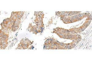 Immunohistochemistry of paraffin-embedded Human colorectal cancer tissue using SLC6A9 Polyclonal Antibody at dilution of 1:25(x200) (GLYT1 抗体)