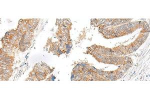 Immunohistochemistry of paraffin-embedded Human colorectal cancer tissue using SLC6A9 Polyclonal Antibody at dilution of 1:25(x200)