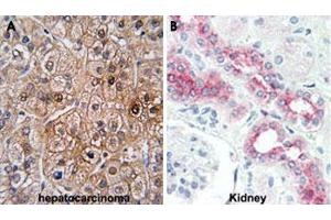 Formalin-fixed and paraffin-embedded human hepatocarcinoma (A) and human kidney (B) tissue reacted with BMPR2 polyclonal antibody , which was peroxidase-conjugated to the secondary antibody, followed by DAB staining. (BMPR2 抗体  (AA 28-59))
