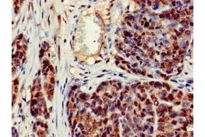 Immunohistochemistry of paraffin-embedded human ovarian cancer using ABIN7150470 at dilution of 1:100 (CRCP 抗体  (AA 1-115))