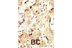 Formalin-fixed and paraffin-embedded human cancer tissue reacted with ERBB4 polyclonal antibody  , which was peroxidase-conjugated to the secondary antibody, followed by DAB staining. (ERBB4 抗体  (N-Term))
