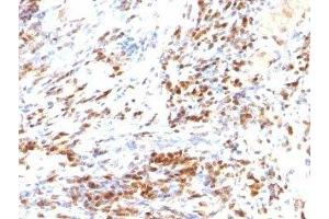 Formalin-fixed, paraffin-embedded human colon carcinoma stained with p27 antibody (DCS-72.