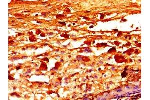 Immunohistochemistry of paraffin-embedded human melanoma using ABIN7152751 at dilution of 1:100 (Fibrillin 1 抗体  (AA 783-850))