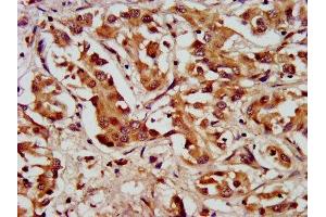 IHC image of ABIN7157898 diluted at 1:200 and staining in paraffin-embedded human liver cancer performed on a Leica BondTM system. (LAMC2 抗体  (AA 417-588))
