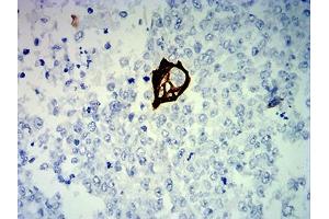 Immunohistochemical analysis of paraffin-embedded breast cancer tissues using KRT13 mouse mAb with DAB staining. (Cytokeratin 13 抗体  (AA 104-458))