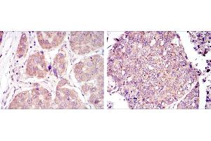 Immunohistochemical analysis of paraffin-embedded liver cancer tissues (left) and lung cancer tissues (right) using HIF1A mouse mAb with DAB staining. (HIF1A 抗体)