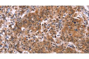 Immunohistochemistry of paraffin-embedded Human gastric cancer tissue using HACE1 Polyclonal Antibody at dilution 1:40 (HACE1 抗体)