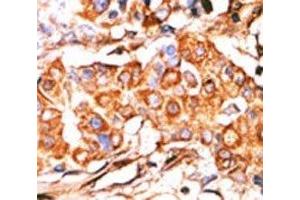 IHC analysis of FFPE human breast carcinoma stained with the Glycerol kinase antibody (GK2 抗体  (AA 487-515))