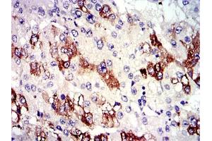 Immunohistochemical analysis of paraffin-embedded liver cancer tissues using TUBA8 mouse mAb with DAB staining. (TUBA8 抗体)