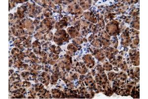 Immunohistochemical staining of paraffin-embedded Adenocarcinoma of Human colon tissue using anti-EPHX2 mouse monoclonal antibody. (EPHX2 抗体)