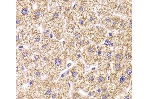 Immunohistochemistry of paraffin-embedded Human liver damage using ST3GAL3 Polyclonal Antibody at dilution of 1:100 (40x lens). (ST3GAL3 抗体)
