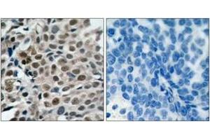 Immunohistochemistry analysis of paraffin-embedded human breast carcinoma, using FKHRL1 (Phospho-Ser253) Antibody. (FOXO3 抗体  (pSer253))