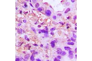 Immunohistochemical analysis of TSG6 staining in human lung cancer formalin fixed paraffin embedded tissue section. (TNFAIP6 抗体  (Center))
