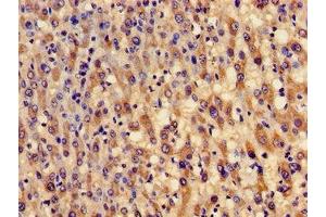 Immunohistochemistry of paraffin-embedded human liver cancer using ABIN7154002 at dilution of 1:100 (GCLM 抗体  (Regulatory Subunit))