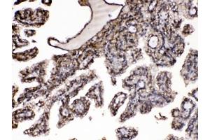 IHC testing of FFPE human renal cancer tissue with Purine nucleoside phosphorylase antibody at 1ug/ml. (PNP 抗体  (AA 161-189))