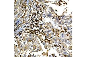 Immunohistochemistry of paraffin-embedded human liver cancer using [KO Validated]  Rabbit pAb (ABIN6133581 and ABIN6136917) at dilution of 1:100 (40x lens). (Annexin a1 抗体)