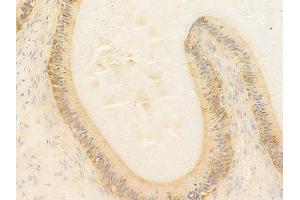 ABIN7097091 and ABIN7101158 at 1/100 staining human testicular cancer by IHC-P. (NCF1C 抗体)