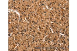 Immunohistochemistry of Human liver cancer using CCNT1 Polyclonal Antibody at dilution of 1:30 (Cyclin T1 抗体)