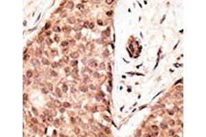 IHC analysis of FFPE human breast carcinoma tissue stained with the CDX2 antibody
