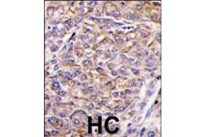 Formalin-fixed and paraffin-embedded human hepatocarcinoma tissue reacted with TAOK3 antibody , which was peroxidase-conjugated to the secondary antibody, followed by DAB staining. (TAO Kinase 3 抗体  (C-Term))