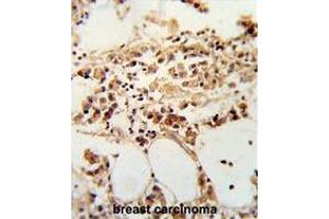 Formalin-fixed and paraffin-embedded human breast carcinoma reacted with TIMP3 Antibody (Center), which was peroxidase-conjugated to the secondary antibody, followed by DAB staining. (TIMP3 抗体  (Middle Region))