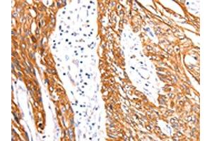 The image on the left is immunohistochemistry of paraffin-embedded Human esophagus cancer tissue using ABIN7192115(Rab3D Antibody) at dilution 1/27, on the right is treated with synthetic peptide. (RAB3D 抗体)
