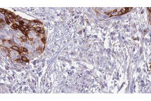 ABIN6273638 at 1/100 staining Human urothelial cancer tissue by IHC-P. (IL12RB1 抗体  (Internal Region))