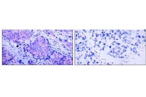 Immunohistochemical analysis of paraffin- embedded human breast carcinoma tissue using PDK1 (phospho-Ser241) antibody (E011005). (PDPK1 抗体  (pSer241))