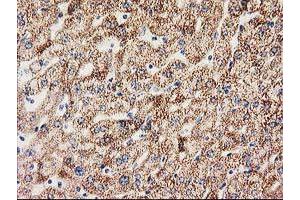 Immunohistochemical staining of paraffin-embedded Human liver tissue using anti-MMAB mouse monoclonal antibody. (MMAB 抗体)