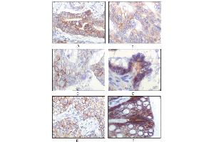 Immunohistochemical analysis of paraffin-embedded human gastric adenocarcinoma(A), golon adenocarcinoma (B), endometrial carcinoma (uterus) (C), ovary adenocarcinoma (D), lung squamous cell carcinoma (E), stomach epithelium mucosae (F), showing membrane localization using IGF1R mouse mAb with DAB staining. (IGF1R 抗体)
