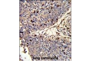Formalin-fixed and paraffin-embedded human lung carcinoma reacted with CFL1 Antibody (N-term), which was peroxidase-conjugated to the secondary antibody, followed by DAB staining. (Cofilin 抗体  (N-Term))