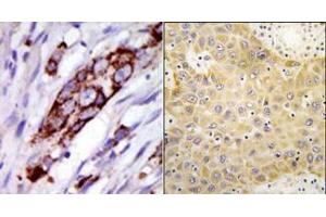 (LEFT)Formalin-fixed and paraffin-embedded human cancer tissue reacted with the primary antibody, which was peroxidase-conjugated to the secondary antibody, followed by DAB staining. (GRK5 抗体  (C-Term))