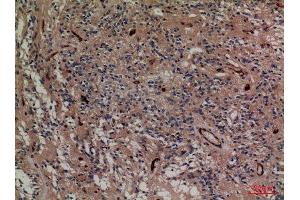 Immunohistochemistry (IHC) analysis of paraffin-embedded Human Ovary Cancer, antibody was diluted at 1:100.