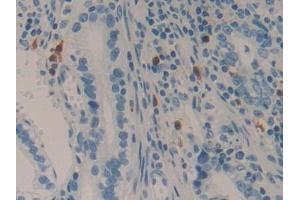 IHC-P analysis of Human Stomach cancer Tissue, with DAB staining. (LAMC2 抗体  (AA 416-602))