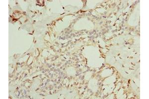 Immunohistochemistry of paraffin-embedded human breast cancer using ABIN7173079 at dilution of 1:100 (TMEM154 抗体  (AA 97-183))