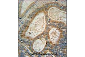 INSIG1 Antibody immunohistochemistry analysis in formalin fixed and paraffin embedded human prostate carcinoma followed by peroxidase conjugation of the secondary antibody and DAB staining. (INSIG1 抗体  (N-Term))
