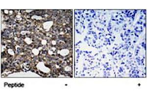 Immunohistochemical analysis of paraffin-embedded human breast carcinoma tissue using GJA1 (phospho S367) polyclonal antibody .