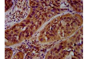 IHC image of ABIN7167931 diluted at 1:600 and staining in paraffin-embedded human cervical cancer performed on a Leica BondTM system. (ARHGAP15 抗体  (AA 1-154))