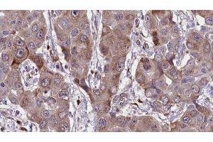 ABIN6276659 at 1/100 staining Human liver cancer tissue by IHC-P. (CD44 抗体  (Internal Region))