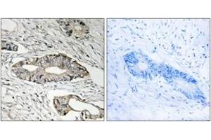 Immunohistochemistry analysis of paraffin-embedded human colon carcinoma tissue, using EPN3 Antibody. (EPN3 抗体  (AA 401-450))