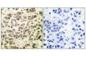 Immunohistochemical analysis of paraffin-embedded human breast carcinoma tissue using HDAC3 antibody. (HDAC3 抗体  (C-Term))