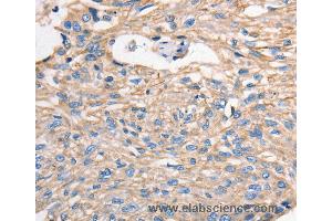 Immunohistochemistry of Human esophagus cancer using MVP Polyclonal Antibody at dilution of 1:40