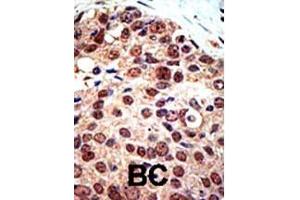 Formalin-fixed and paraffin-embedded human cancer tissue reacted with the primary antibody, which was peroxidase-conjugated to the secondary antibody, followed by DAB staining. (PRMT3 抗体  (C-Term))