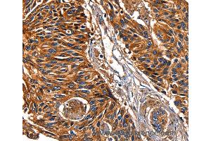 Immunohistochemistry of Human lung cancer using LGALS8 Polyclonal Antibody at dilution of 1:50 (LGALS8 抗体)
