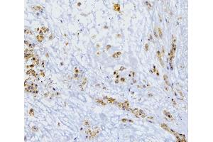 IHC analysis of SQSTM1 using anti-SQSTM1 antibody (ABIN3043937).